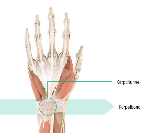 Anatomie-Grafik der linken Hand mit Markierung des Karpaltunnels und des Karpalbandes