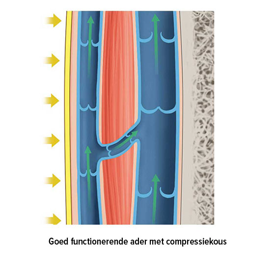 Goed functionerende ader met compressiekous Goed functionerende ader met compressiekous