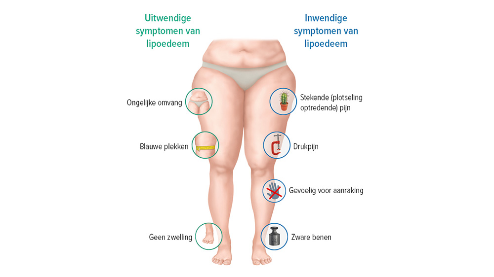 Grafische weergave symptomen lipoedeem Grafische weergave symptomen lipoedeem
