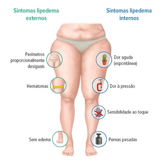 Sintomas gráficos de lipoedema