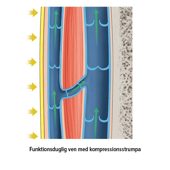 Funktionsduglig ven med kompressionsstrumpa Funktionsduglig ven med kompressionsstrumpa