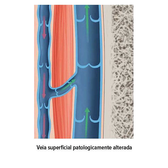 Veia superficial patologicamente alterada