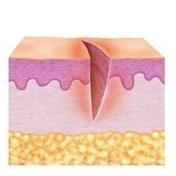 1. Fase da limpeza (fase de exsudação)