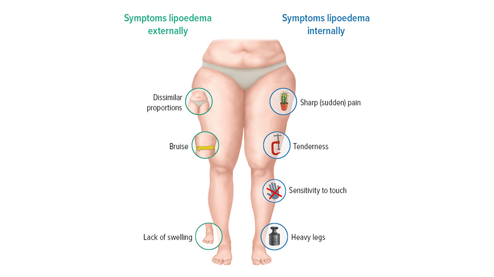 Diagram lipoedema symptoms Diagram lipoedema symptoms