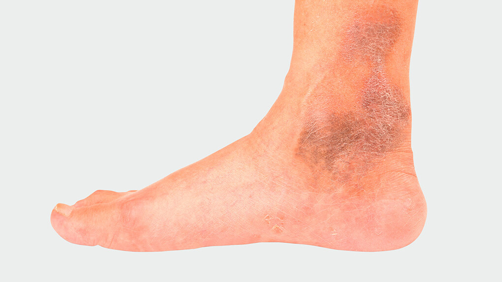 Jambe Avec IVC