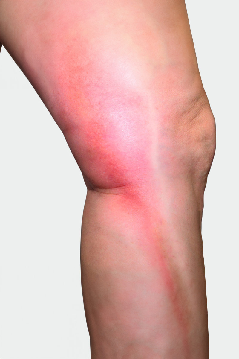 Trombose Perna com sintomas de trombose