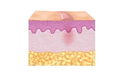 3. Reparationsfase (epitelisering)