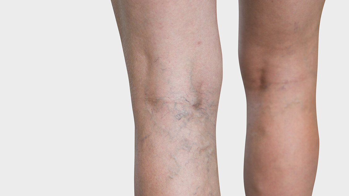 Beininnenseite, an der man Besenreiser sieht Beininnenseite, an der man Besenreiser sieht